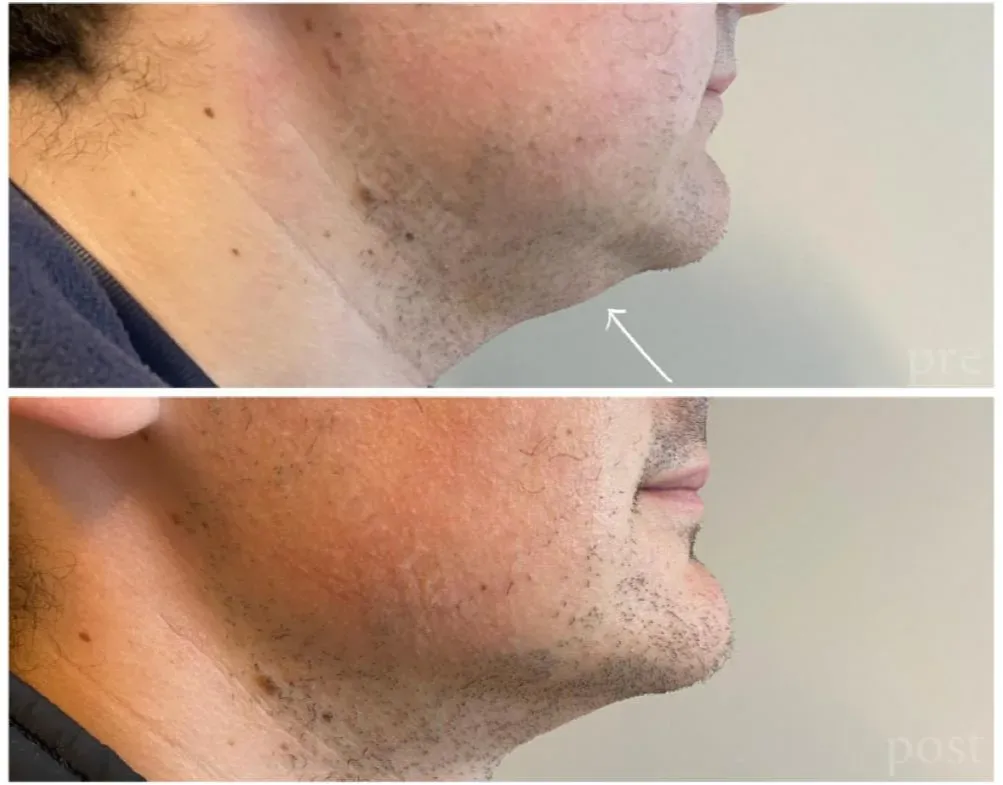Filler Full Face